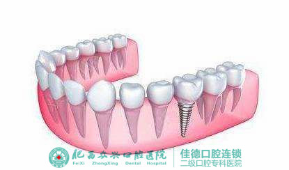 种植牙可以去肥西哪家？