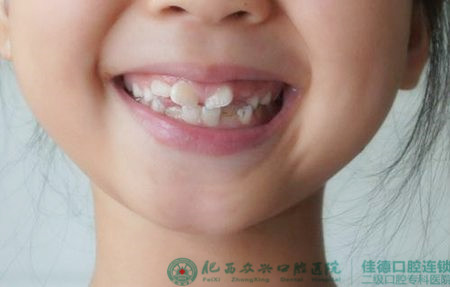 儿童矫正牙齿是否要拔牙?